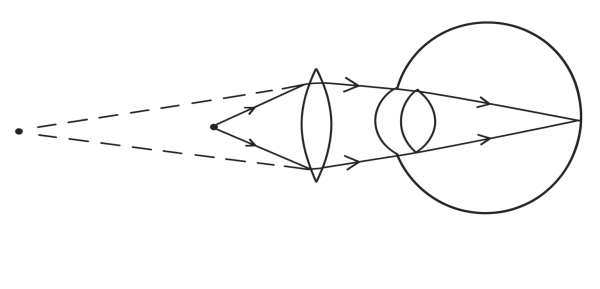 Corrective measure for vision defect